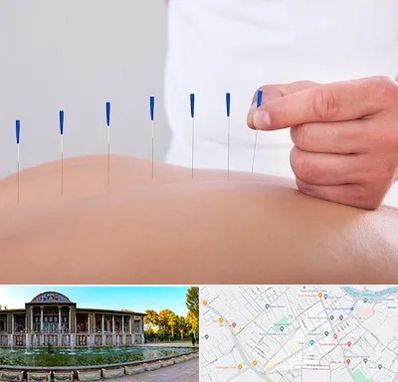 دکتر طب سوزنی در عفیف آباد شیراز