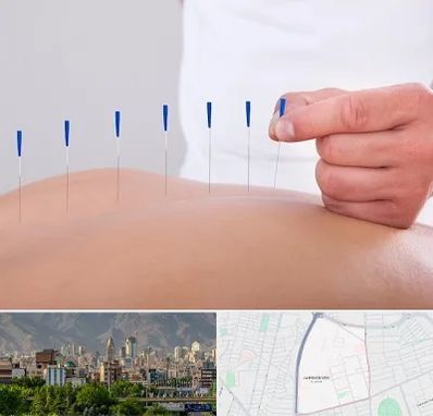 دکتر طب سوزنی در جمشیدیه