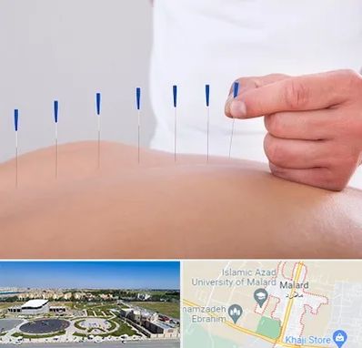 دکتر طب سوزنی در ملارد