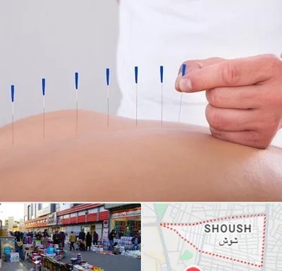دکتر طب سوزنی در شوش