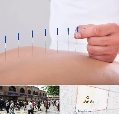 دکتر طب سوزنی در بازار تهران