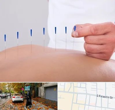 دکتر طب سوزنی در خیابان فلسطین