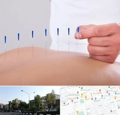 دکتر طب سوزنی در میدان کاج