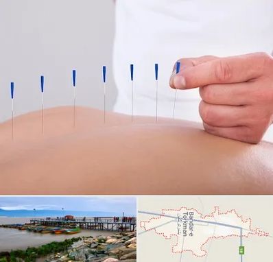 دکتر طب سوزنی در بندر ترکمن