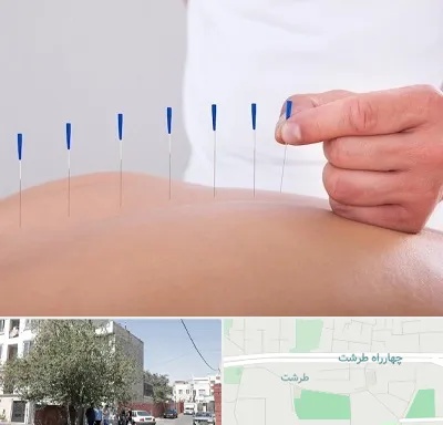 دکتر طب سوزنی در طرشت