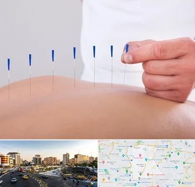 دکتر طب سوزنی در منطقه 7 تهران