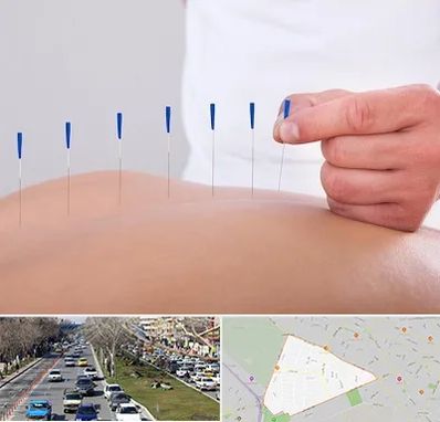 دکتر طب سوزنی در احمدآباد مشهد