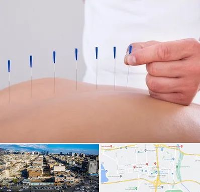 دکتر طب سوزنی در شهرک راه آهن