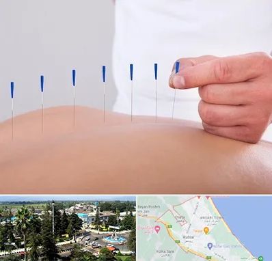 دکتر طب سوزنی در رودسر