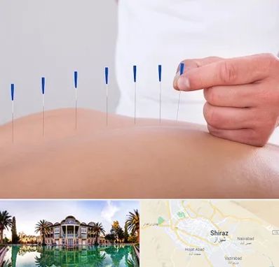 دکتر طب سوزنی در شیراز