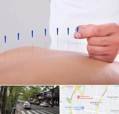 دکتر طب سوزنی در ظفر 