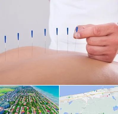 دکتر طب سوزنی در فریدونکنار