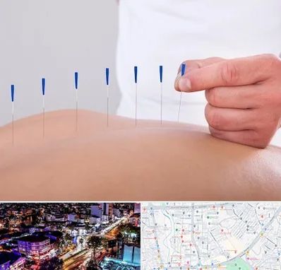 دکتر طب سوزنی در منظریه رشت