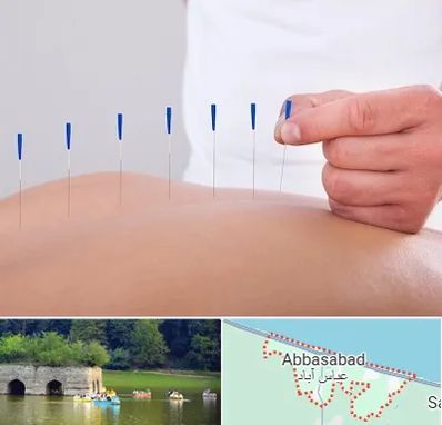 دکتر طب سوزنی در عباس آباد