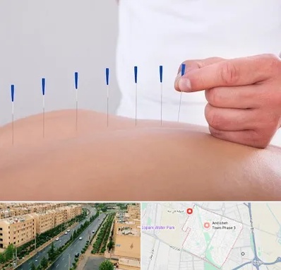 دکتر طب سوزنی در فاز سه اندیشه