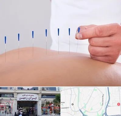 دکتر طب سوزنی در ایران زمین