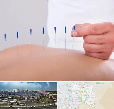 دکتر طب سوزنی در منطقه 15 تهران