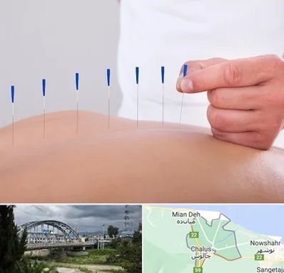 دکتر طب سوزنی در چالوس