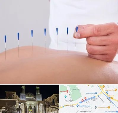 دکتر طب سوزنی در زرگری شیراز