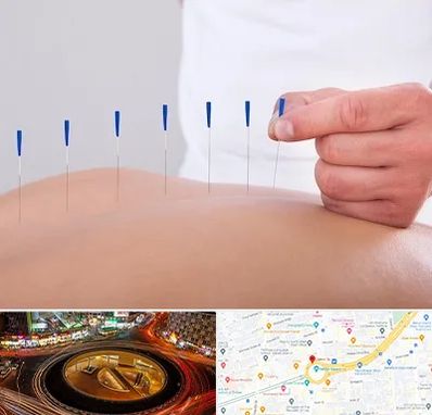 دکتر طب سوزنی در میدان ولیعصر