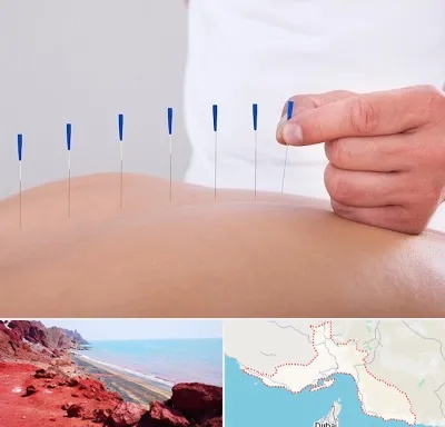 دکتر طب سوزنی در هرمزگان