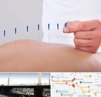 دکتر طب سوزنی در پارک وی