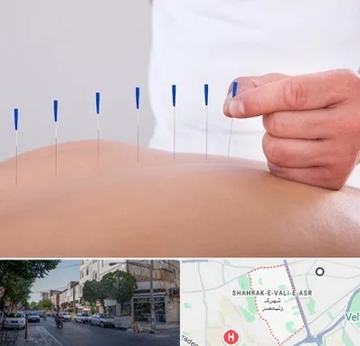 دکتر طب سوزنی در شهرک ولیعصر