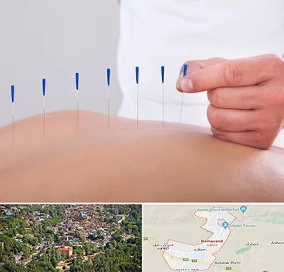 دکتر طب سوزنی در دماوند