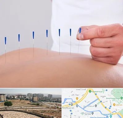 دکتر طب سوزنی در کوی وحدت شیراز