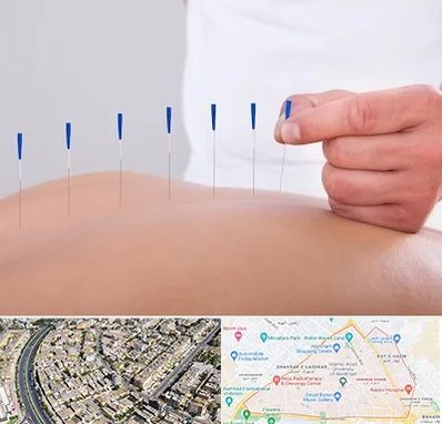 دکتر طب سوزنی در شهرک غرب مشهد