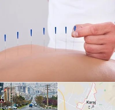 دکتر طب سوزنی در گوهردشت کرج 