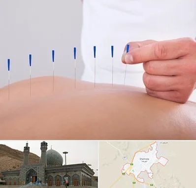 دکتر طب سوزنی در شهرضا