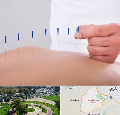 دکتر طب سوزنی در مهرشهر کرج 