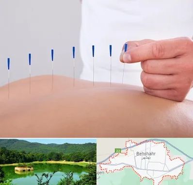 دکتر طب سوزنی در بهشهر