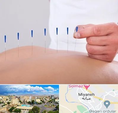 دکتر طب سوزنی در میانه