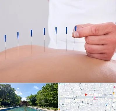 دکتر طب سوزنی در هشت بهشت اصفهان