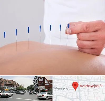 دکتر طب سوزنی در خیابان آذربایجان