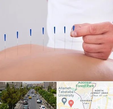 دکتر طب سوزنی در شهران 