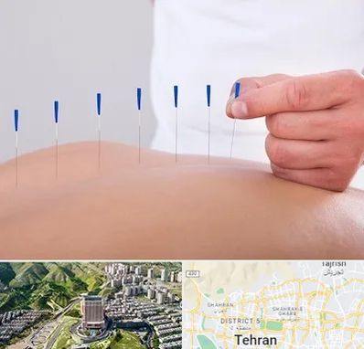 دکتر طب سوزنی در شمال تهران