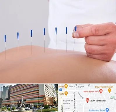 دکتر طب سوزنی در سهروردی 