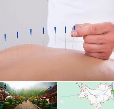 دکتر طب سوزنی در فومن