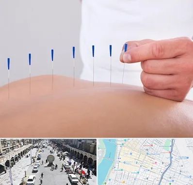 دکتر طب سوزنی در نادری اهواز