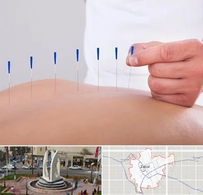 دکتر طب سوزنی در زابل