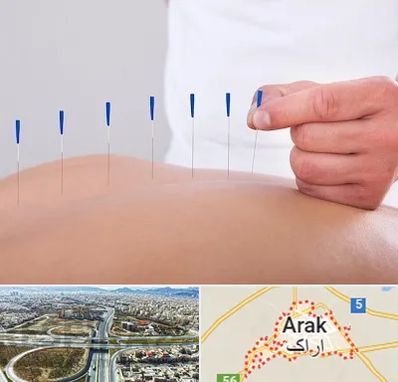 دکتر طب سوزنی در اراک