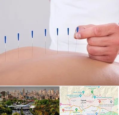 دکتر طب سوزنی در منطقه 1 تهران