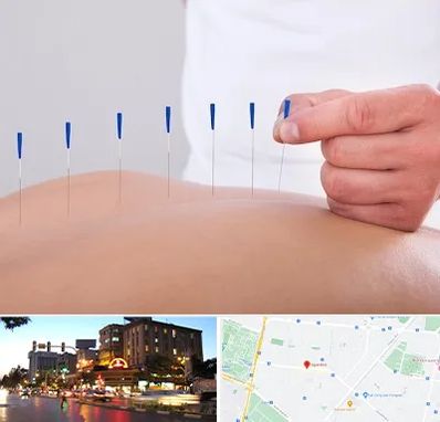 دکتر طب سوزنی در بلوار سجاد مشهد