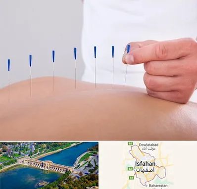 دکتر طب سوزنی در اصفهان