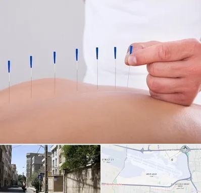 دکتر طب سوزنی در مهرآباد