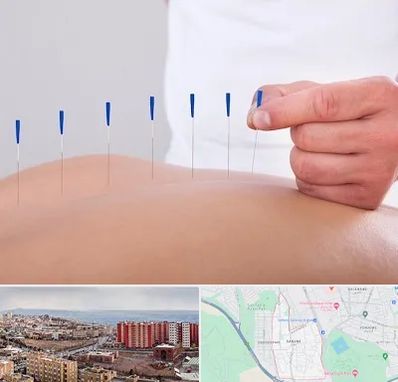 دکتر طب سوزنی در سهند تبریز