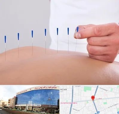 دکتر طب سوزنی در نصف راه تبریز